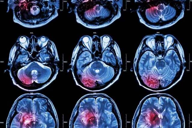 Brain cancer can be cured if it's detected early.